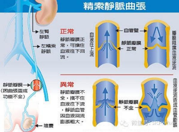 關(guān)于2021年征兵精索靜脈曲張標(biāo)準(zhǔn)的探討，2021年征兵精索靜脈曲張標(biāo)準(zhǔn)深度解析