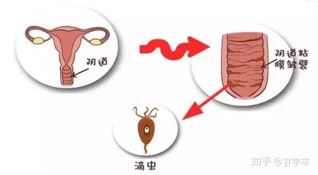 如何分清自己哪種婦科炎癥,如何辨別不同類型的婦科炎癥